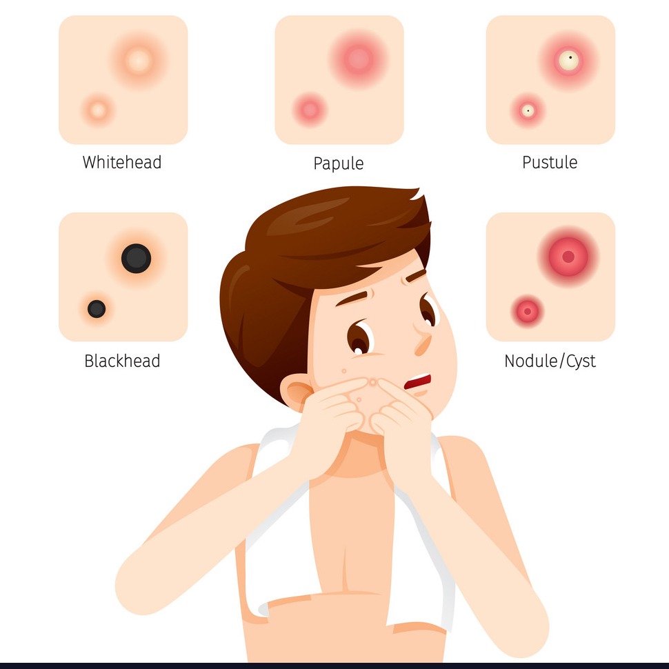 Acne Guide by alam care