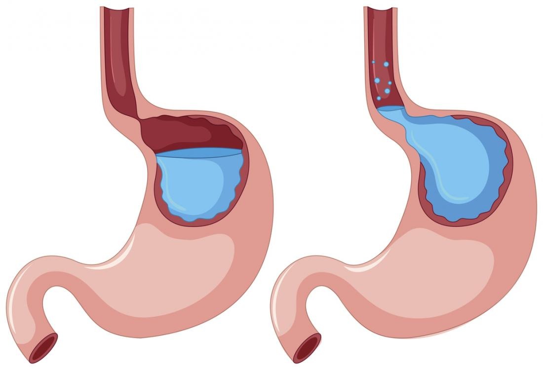 Acid Reflux by alam care